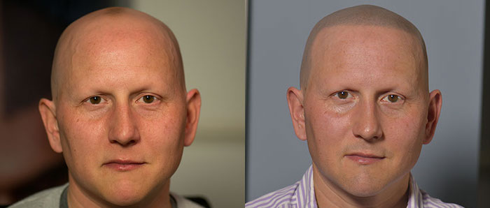 chris alopecia treatment
