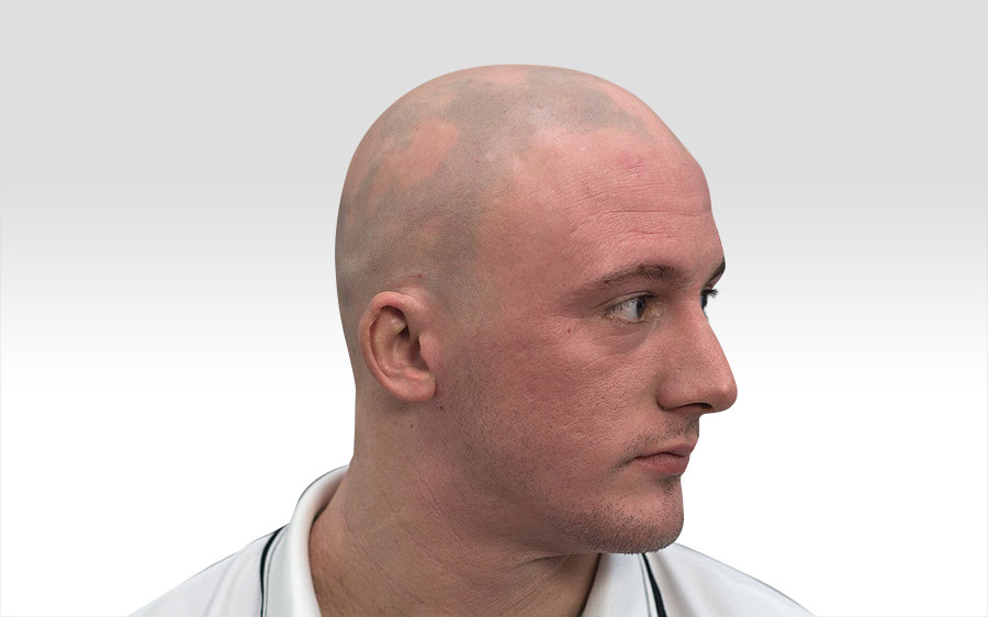 Scalp micropigmentation and side profiles - His Hair Clinic