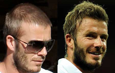 David Beckham hair transplant