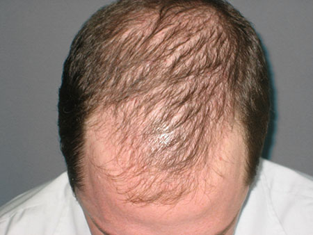 androgenetic alopecia