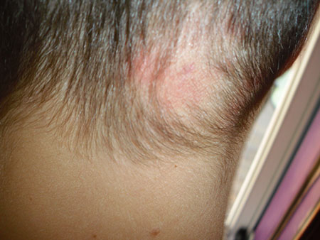 scarring alopecia