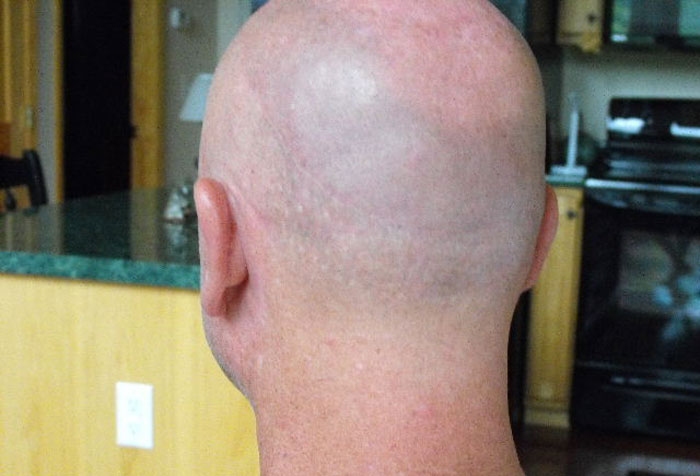 Fraxel laser repair for hair transplant scars - His Hair Clinic