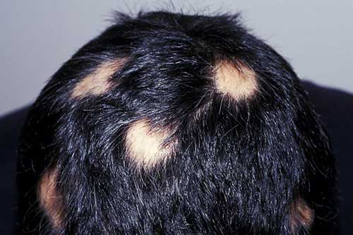what causes alopecia areata