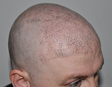 scalp pigmentation (not HIS)