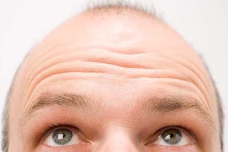 baldness prostate cancer
