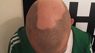 alopecia-1
