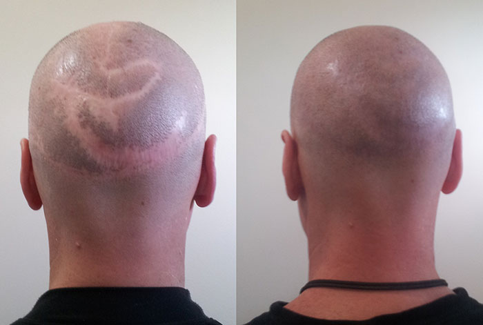 scalp-reduction-scar-repair