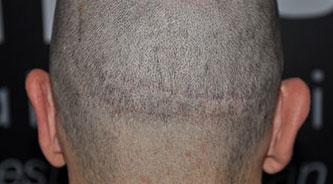 Hair transplant scar repair using SMP techniques - His Hair Clinic