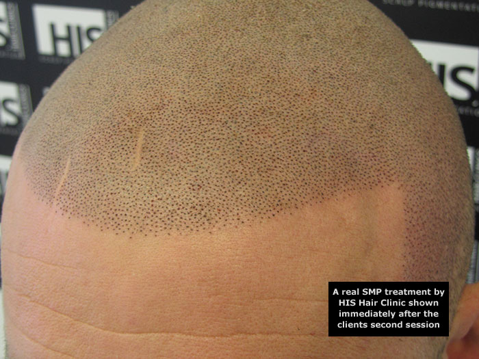 Scalp MicroPigmentation after two sessions