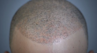 Bad Hair Tattoo Repair after Hair Transplant Nightmare (part 1) - His Hair  Clinic