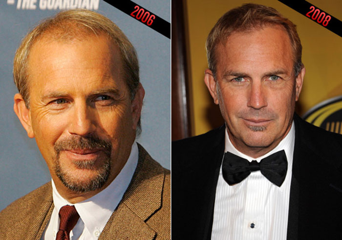 Kevin Costners hair transplant in 2008 - before and after