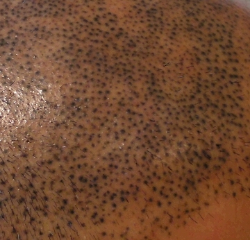 Banishing Bad Ink: A Quick Look at Laser Removal - His Hair Clinic