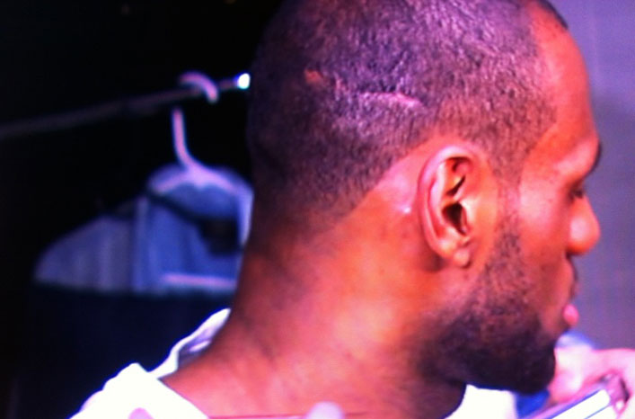 LeBron James hair transplant scar