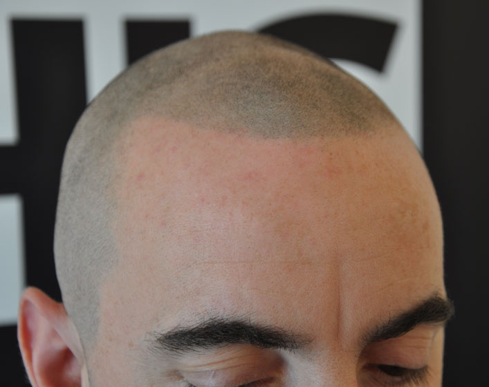 camouflage for male pattern baldness