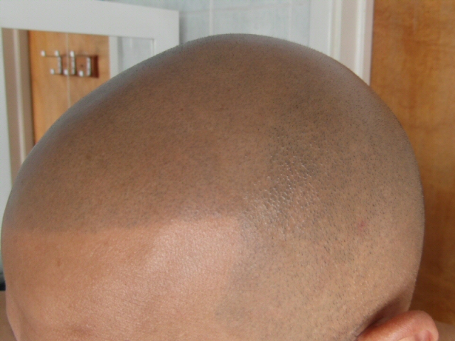 Hair Tattoo What Is Scalp Micropigmentation Cost Before  After Pics