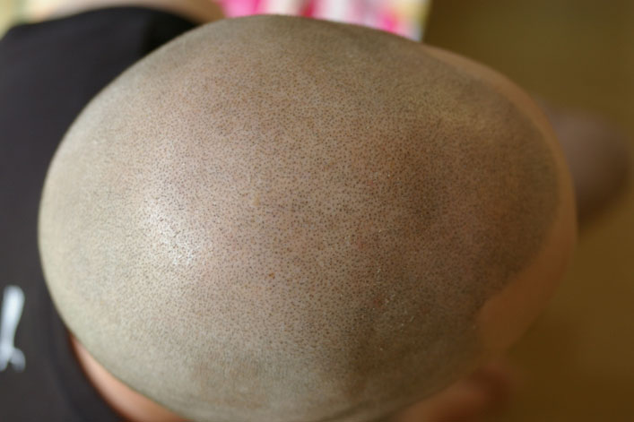 Scalp from above