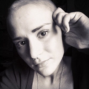 alopecia areata sufferer