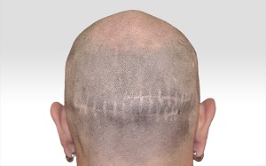 hair transplant scars