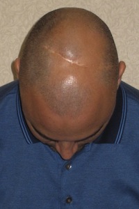 I want to shave my head but I have a scar on my scalp – what can I do? -  His Hair Clinic