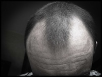 balding head