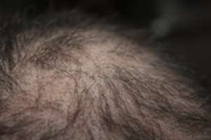 thinning hair dos and don'ts