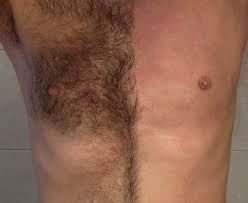 patient satisfaction from body hair transplants