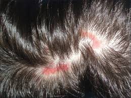 lichen scalp