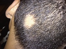 Alopecia: The lowdown
