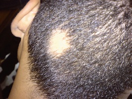 alopecia areata: what is it and can it be treated?