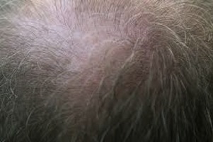Researchers get one step closer to discovering cause of hair loss