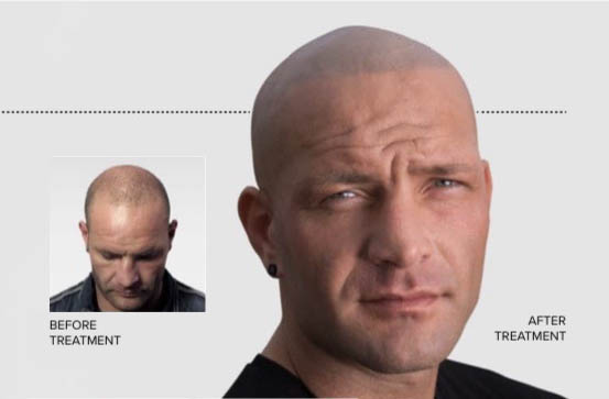 How much does Scalp Micropigmentation Cost?
